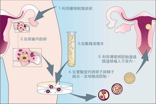 长沙高龄二代试管婴儿成功率_健康-如何检查卵巢囊肿？