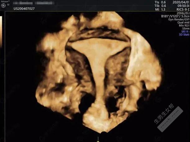 影像学看子宫异常]四维超声子宫输卵管造影，能否准确筛查和对症治疗 ...